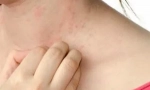 Kako se riješiti škabie: metode liječenja